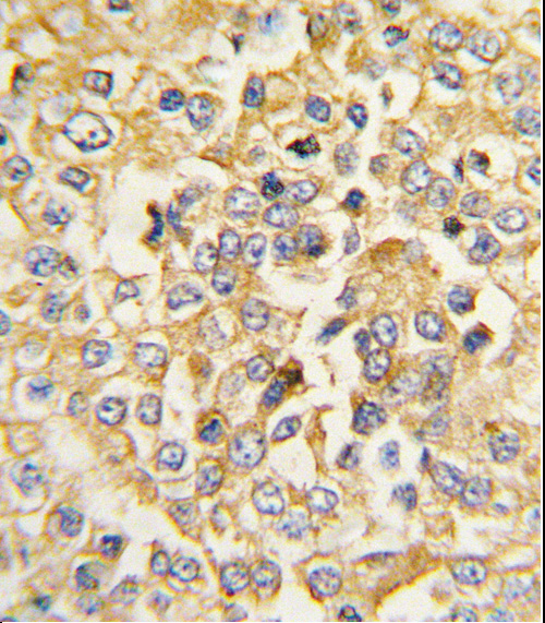 Formalin-fixed and paraffin-embedded human breast carcinoma tissue reacted with Natriuretic Peptide Receptor A (NPR1/ANPA) antibody (N-term) (Cat. #AP8111a), which was peroxidase-conjugated to the secondary antibody, followed by DAB staining. This data demonstrates the use of this antibody for immunohistochemistry; clinical relevance has not been evaluated.