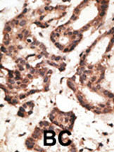 Formalin-fixed and paraffin-embedded human cancer tissue reacted with the primary antibody, which was peroxidase-conjugated to the secondary antibody, followed by DAB staining. This data demonstrates the use of this antibody for immunohistochemistry; clinical relevance has not been evaluated. BC = breast carcinoma; HC = hepatocarcinoma.