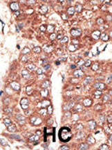 Formalin-fixed and paraffin-embedded human cancer tissue reacted with the primary antibody, which was peroxidase-conjugated to the secondary antibody, followed by AEC staining. This data demonstrates the use of this antibody for immunohistochemistry; clinical relevance has not been evaluated. BC = breast carcinoma; HC = hepatocarcinoma.