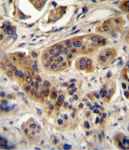 ACOX1 Antibody (N-term) (Cat. #AP2523A)immunohistochemistry analysis in formalin fixed and paraffin embedded human bladder carcinoma followed by peroxidase conjugation of the secondary antibody and DAB staining.This data demonstrates the use of ACOX1 Antibody (N-term) for immunohistochemistry.  Clinical relevance has not been evaluated.