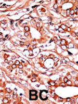 Formalin-fixed and paraffin-embedded human cancer tissue reacted with the primary antibody, which was peroxidase-conjugated to the secondary antibody, followed by AEC staining. This data demonstrates the use of this antibody for immunohistochemistry; clinical relevance has not been evaluated. BC = breast carcinoma; HC = hepatocarcinoma.