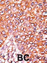 Formalin-fixed and paraffin-embedded human cancer tissue reacted with the primary antibody, which was peroxidase-conjugated to the secondary antibody, followed by AEC staining. This data demonstrates the use of this antibody for immunohistochemistry; clinical relevance has not been evaluated. BC = breast carcinoma; HC = hepatocarcinoma.