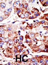 Formalin-fixed and paraffin-embedded human cancer tissue reacted with the primary antibody, which was peroxidase-conjugated to the secondary antibody, followed by DAB staining. This data demonstrates the use of this antibody for immunohistochemistry; clinical relevance has not been evaluated. BC = breast carcinoma; HC = hepatocarcinoma.