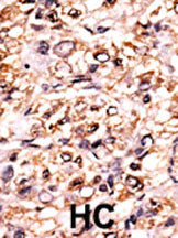 Formalin-fixed and paraffin-embedded human cancer tissue reacted with the primary antibody, which was peroxidase-conjugated to the secondary antibody, followed by DAB staining. This data demonstrates the use of this antibody for immunohistochemistry; clinical relevance has not been evaluated. BC = breast carcinoma; HC = hepatocarcinoma.