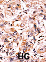 Formalin-fixed and paraffin-embedded human cancer tissue reacted with the primary antibody, which was peroxidase-conjugated to the secondary antibody, followed by AEC staining. This data demonstrates the use of this antibody for immunohistochemistry; clinical relevance has not been evaluated. BC = breast carcinoma; HC = hepatocarcinoma