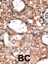 Formalin-fixed and paraffin-embedded human cancer tissue reacted with the primary antibody, which was peroxidase-conjugated to the secondary antibody, followed by AEC staining. This data demonstrates the use of this antibody for immunohistochemistry; clinical relevance has not been evaluated. BC = breast carcinoma; HC = hepatocarcinoma.