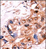 Formalin-fixed and paraffin-embedded human cancer tissue reacted with the primary antibody, which was peroxidase-conjugated to the secondary antibody, followed by AEC staining. This data demonstrates the use of this antibody for immunohistochemistry; clinical relevance has not been evaluated. BC = breast carcinoma; HC = hepatocarcinoma