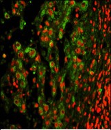 Immunofluorescence analysis of ITGAX Antibody (C-term) with paraffin-embedded human hepatocarcinoma . 0.05 mg/ml primary antibody was followed by FITC-conjugated goat anti-rabbit lgG (whole molecule). FITC emits green fluorescence.Red counterstaining is PI.