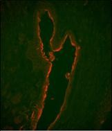 Immunofluorescence analysis of LTF Monoclonal Antibody with paraffin-embedded human prostate carcinoma tissue . 0.05 mg/ml primary antibody was followed by PE-conjugated goat anti-mouse lgG (whole molecule). PE emits orange fluorescence.