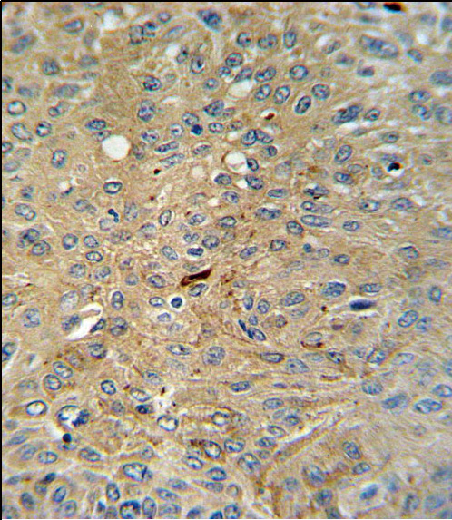 Cleaved-CASP3 (Asp175)Antibody (Cat. #AP3725a) IHC analysis in formalin fixed and paraffin embedded human lung carcinoma followed by peroxidase conjugation of the secondary antibody and DAB staining.  This data demonstrates the use of the Cleaved-CASP3 (Asp175)Antibody for immunohistochemistry.  Clinical relevance has not been evaluated.