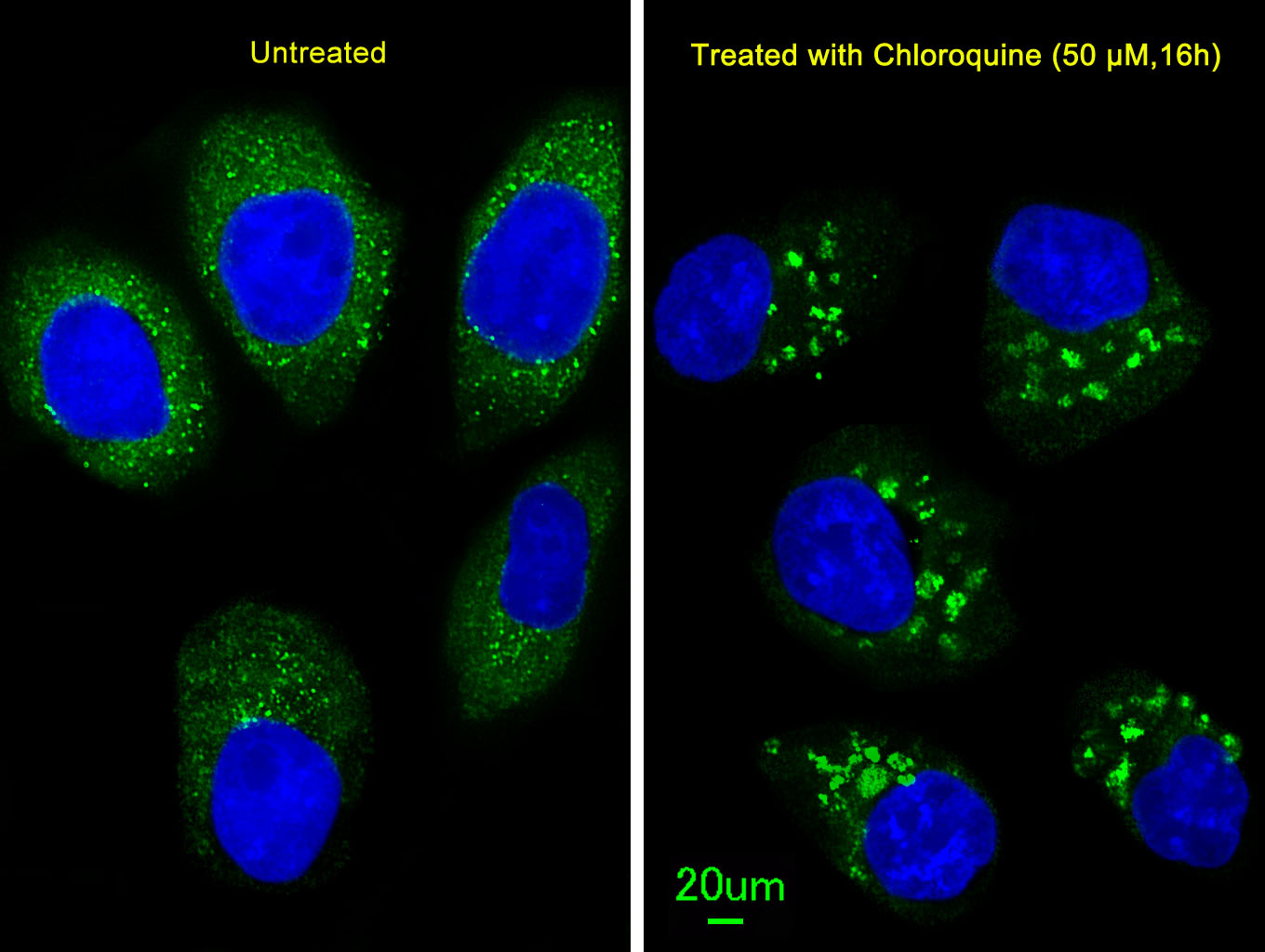 Immunofluorescent analysis of U251 cells, using LC3 Antibody (APG8B) (N-term)(Cat. #AP1802a). U251 cells(right) were treated with Chloroquine (50 ?M,16h). AP1802a was diluted at 1:100 dilution. Alexa Fluor 488-conjugated goat anti-rabbit lgG at 1:400 dilution was used as the secondary antibody (green).DAPI was used to stain the cell nuclear (blue).