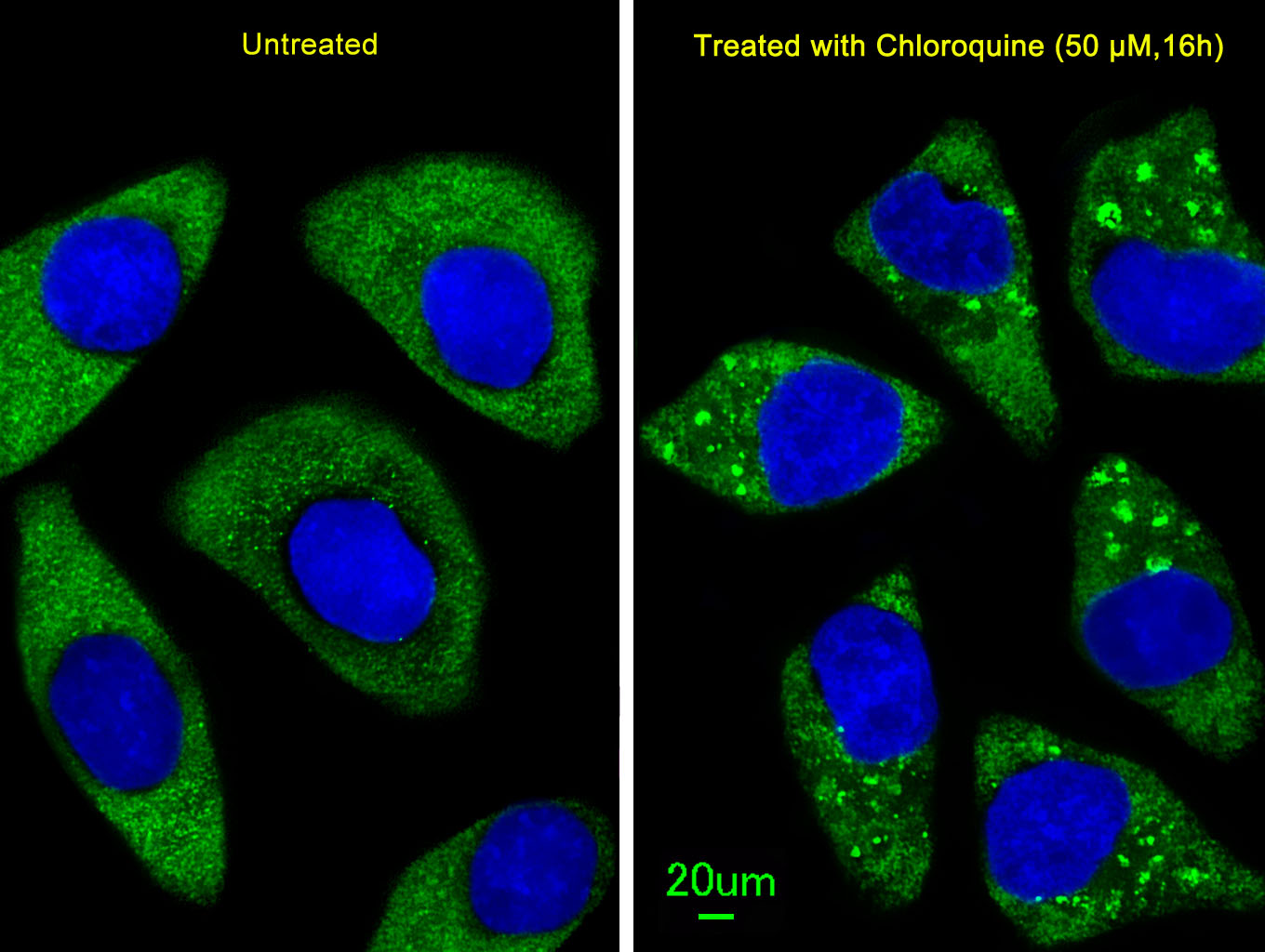 Immunofluorescent analysis of U251 cells, using ATG7 Antibody (C-term) (Cat. #AP1813d). U251 cells(right) were treated with Chloroquine (50 ?M,16h). AP1813d was diluted at 1:25 dilution. Alexa Fluor 488-conjugated goat anti-rabbit lgG at 1:400 dilution was used as the secondary antibody (green).DAPI was used to stain the cell nuclear (blue).