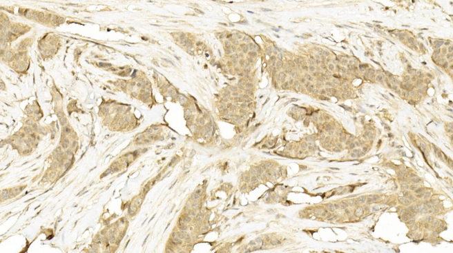 Immunohistochemical analysis of paraffin-embedded Human Breast cancer section using Pink1(Cat#AM 8417b). AM 8417b was diluted at 1:100 dilution. A undiluted biotinylated goat polyvalent antibody was used as the secondary, followed by DAB staining.