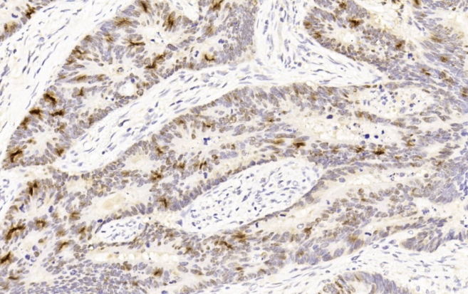 Immunohistochemical analysis of paraffin-embedded Human Colon cancer section using Pink1(Cat#AM8574b). AM8574b was diluted at 1:400 dilution. A undiluted biotinylated goat polyvalent antibody was used as the secondary, followed by DAB staining.