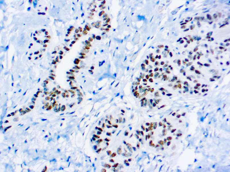 IHC - WILMS TUMOR 1 PROTEIN (WT1) ADB1529-1